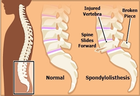 Spondylolisthesis, Spondylolysis, and Spondylosis: Understanding the Differences 1 image1