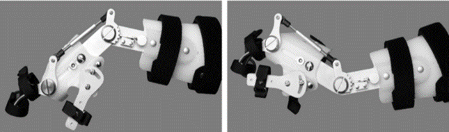 Spinal Cord Injury and Its Orthotic Management 17 Wrist-driven orthosis (tenodesis splint):