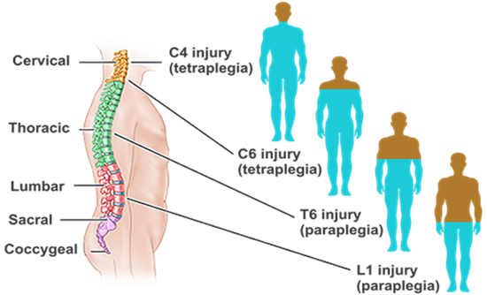 Spinal Cord Injury and Its Orthotic Management 2 Spinal Cord Injury (SCI)