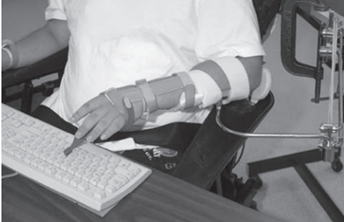 Spinal Cord Injury and Its Orthotic Management 15 Mobile Arm Supports (MAS)