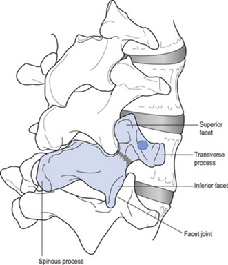 Spondylolisthesis, Spondylolysis, and Spondylosis: Understanding the Differences 6 image6
